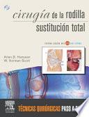 Cirugia de la Rodilla Sustitucion Total